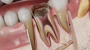 Чем опасно откладывать лечение пульпита: реальные последствия